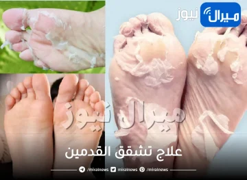 13 علاج طبيعي لتشقق القدمين