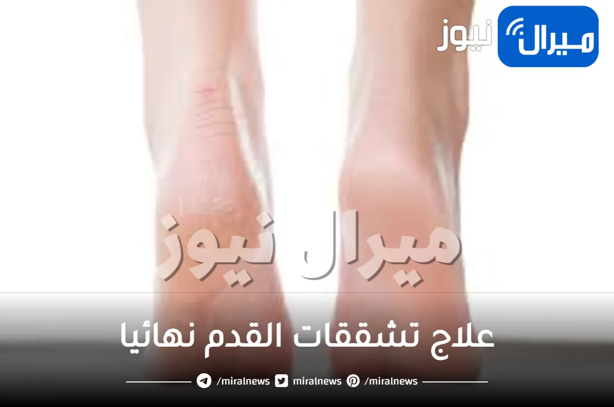 علاج تشققات القدم نهائيا