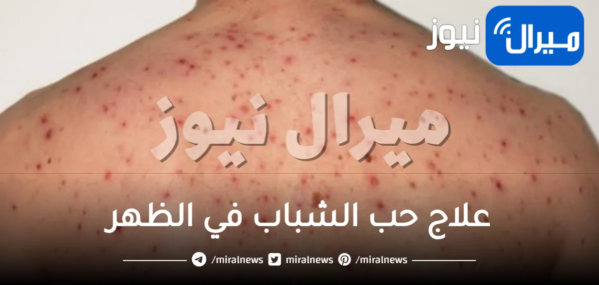 “طبيعيا”علاج حب الشباب في الظهر