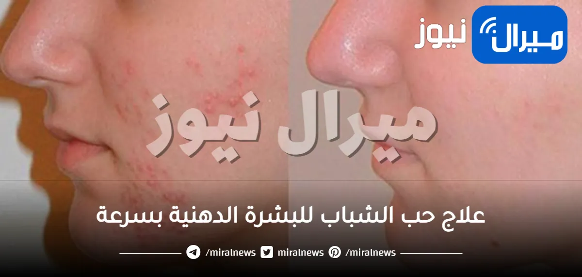 علاج حب الشباب للبشرة الدهنية بسرعة