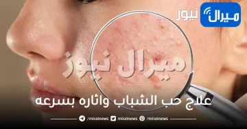 علاج حب الشباب واثاره بسرعه