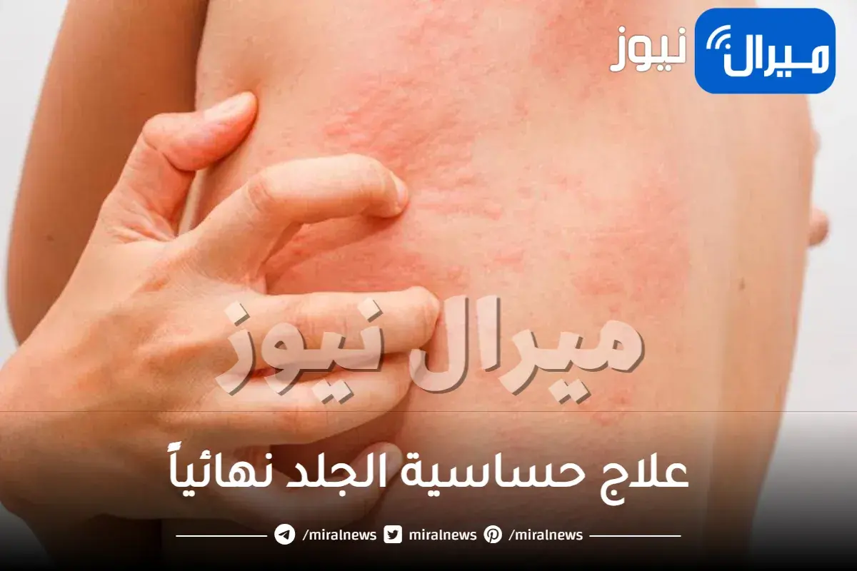 علاج حساسية الجلد نهائياً