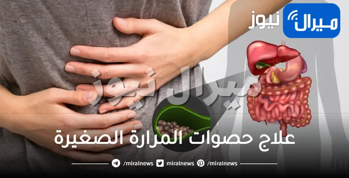 علاج حصوات المرارة الصغيرة