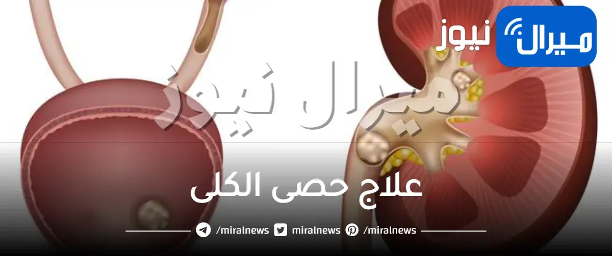علاج حصى الكلى