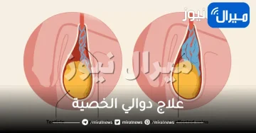 علاج دوالي الخصية طبيعيا بالثلج والثوم وزيت الزيتون