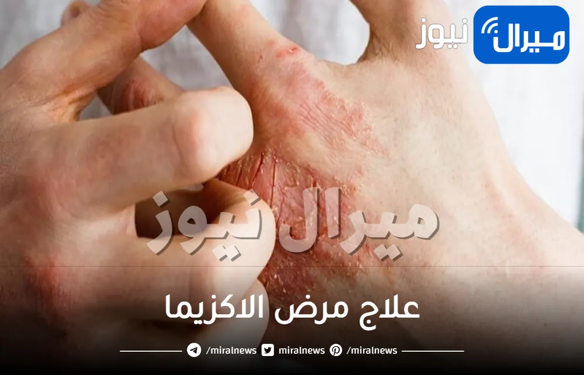 أفضل 12 طريقة لعلاج مرض الاكزيما