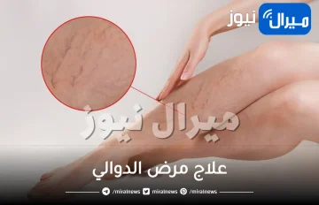 10 طرق طبيعية لعلاج مرض الدوالي