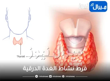 فرط نشاط الغدة الدرقية .. أسباب الإصابة بفرط نشاط الغدة الدرقية وعلاجها