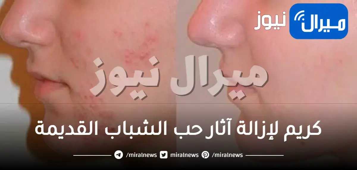 كريم لإزالة آثار حب الشباب القديمة للبشرة الدهنية من أول استعمال تجربتي في 7 أيام