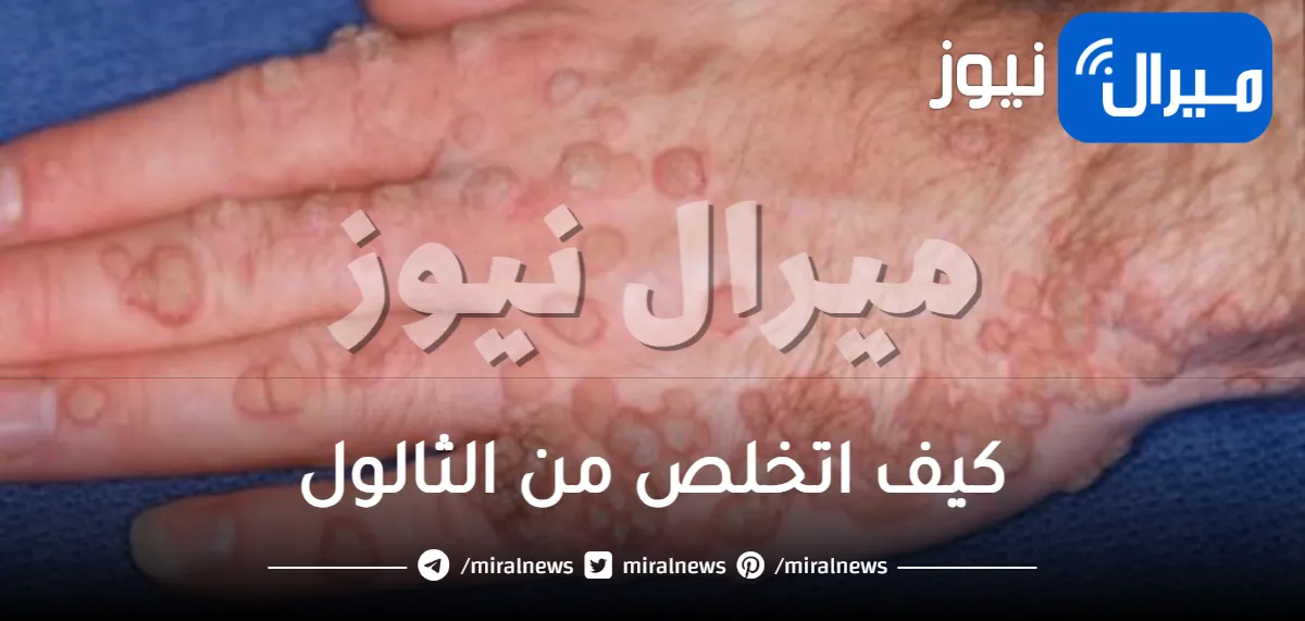 كيف اتخلص من الثالول .. 7 علاجات