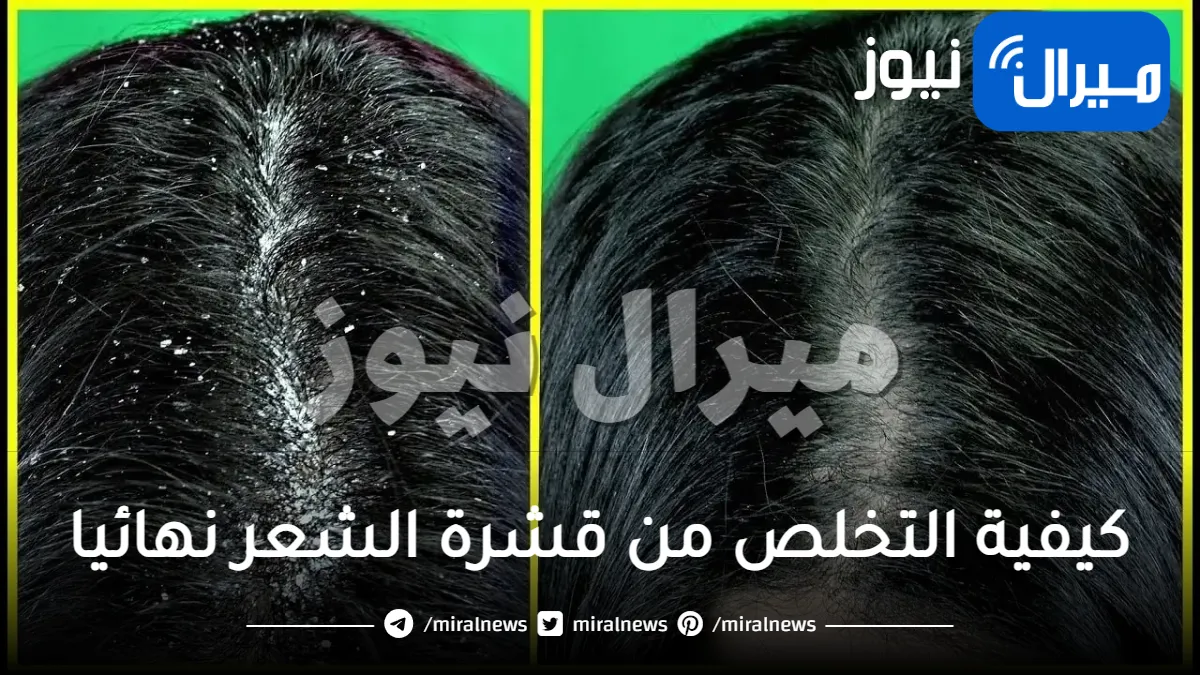 كيفية التخلص من قشرة الشعر نهائيا
