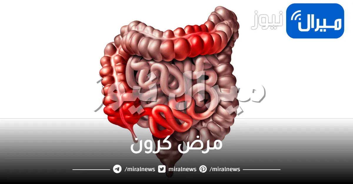 مرض كرون واعراضه واسبابه وعلاجه وكيفية تشخيصه