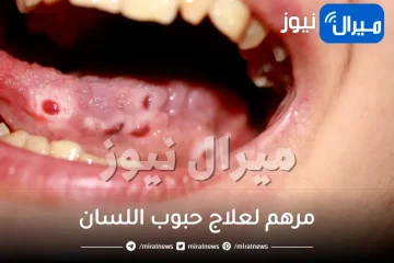 مرهم لعلاج حبوب اللسان