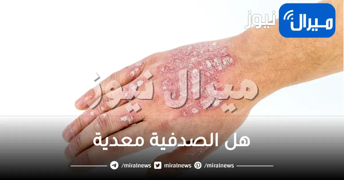 هل الصدفية معدية
