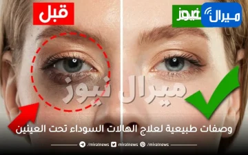وصفات طبيعية لعلاج الهالات السوداء تحت العينين