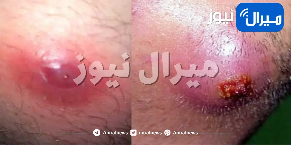 أعراض وعلاج الخراريج