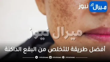 أفضل طريقة للتخلص من البقع الداكنة