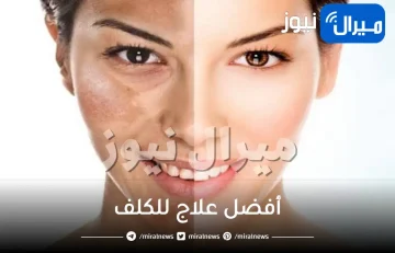 أفضل علاج للكلف