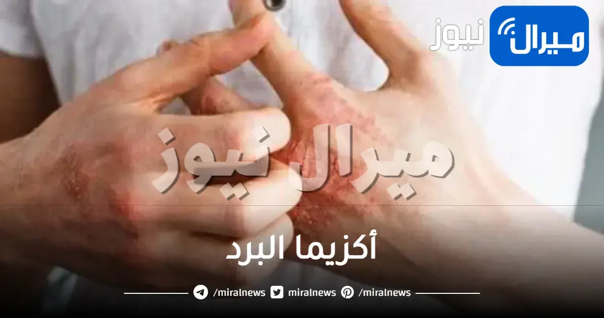 أكزيما البرد