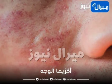 أكزيما الوجه.. أسبابها وأعراضها وأفضل طرق علاجها