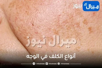 أنواع الكلف في الوجه