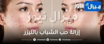 آلية إزالة حب الشباب بالليزر ومحاذيره