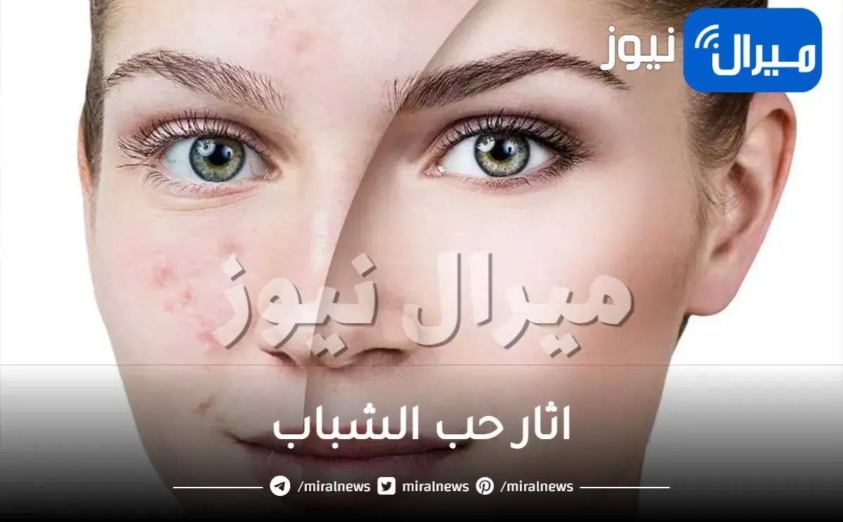 أنواع اثار حب الشباب الشائعة وطرق علاجها