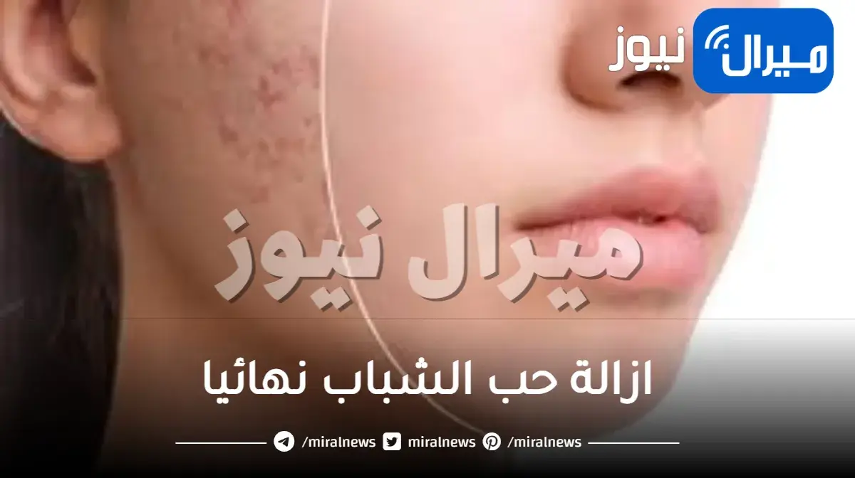 طريقة ازالة حب الشباب نهائيا