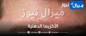 الأكزيما الدهنية..أسبابها وأعراض ظهورها