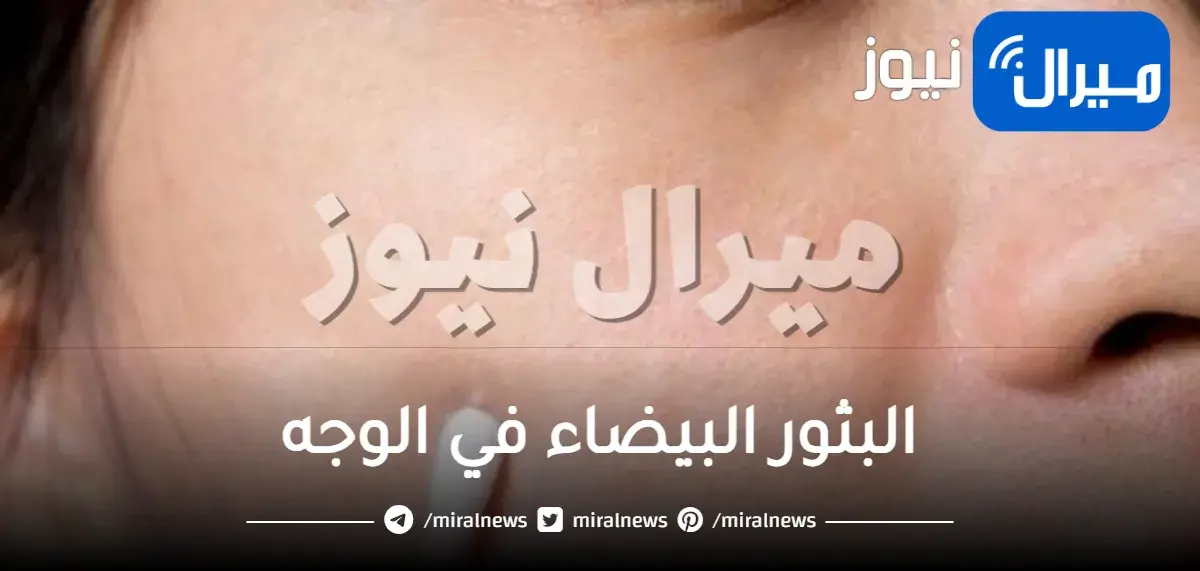 ليست حبوباً عادية.. أسباب البثور البيضاء في الوجه وأسرار التخلص منها نهائياً بدون ترك أثر