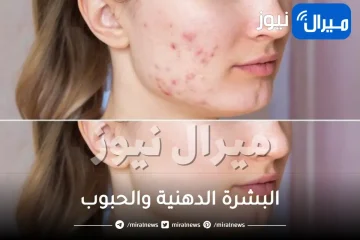 البشرة الدهنية والحبوب