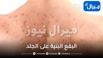 البقع البنية على الجلد .. أسبابها وطرق علاجها