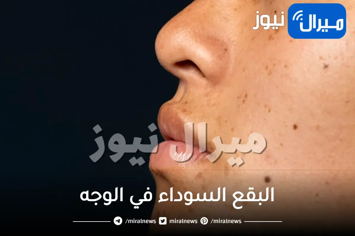 البقع السوداء في الوجه.. أسباب ظهورها وكيف أتخلص منها