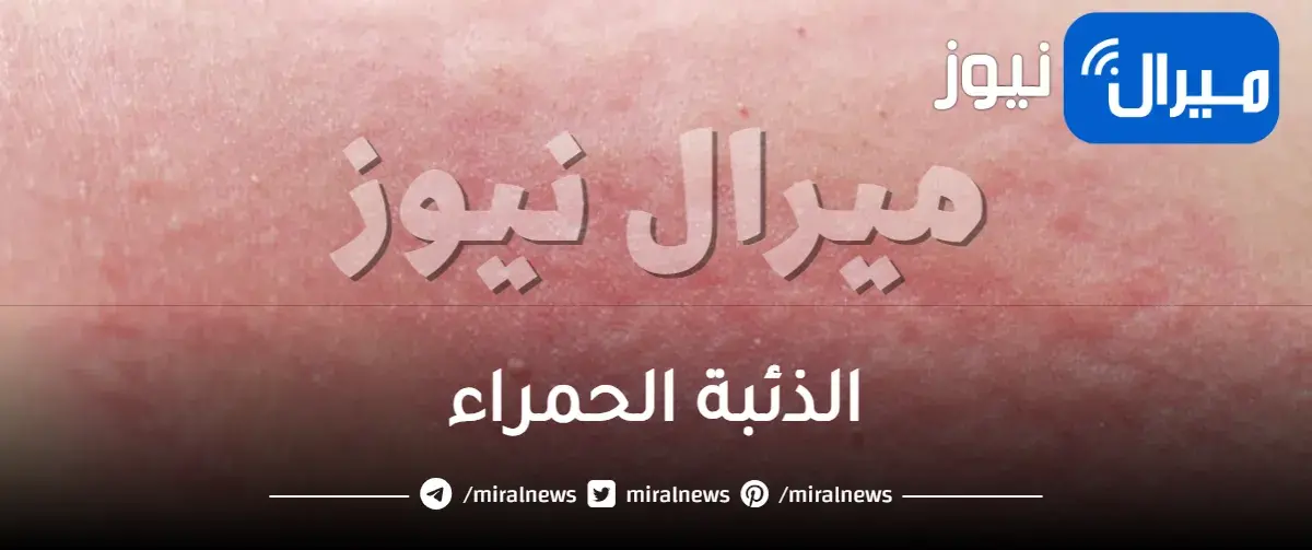 مرض الذئبة الحمراء و هل مرض الذئبة الحمراء يسبب الوفاة
