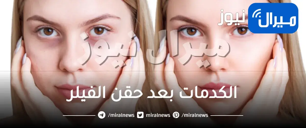 الكدمات بعد حقن الفيلر