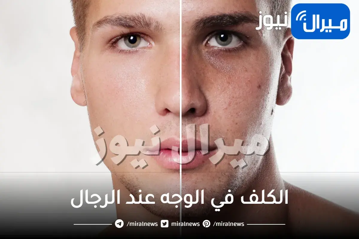 الكلف في الوجه عند الرجال