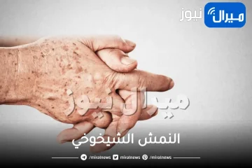 النمش الشيخوخي: أسبابه، علاجه، طرق الوقاية منه