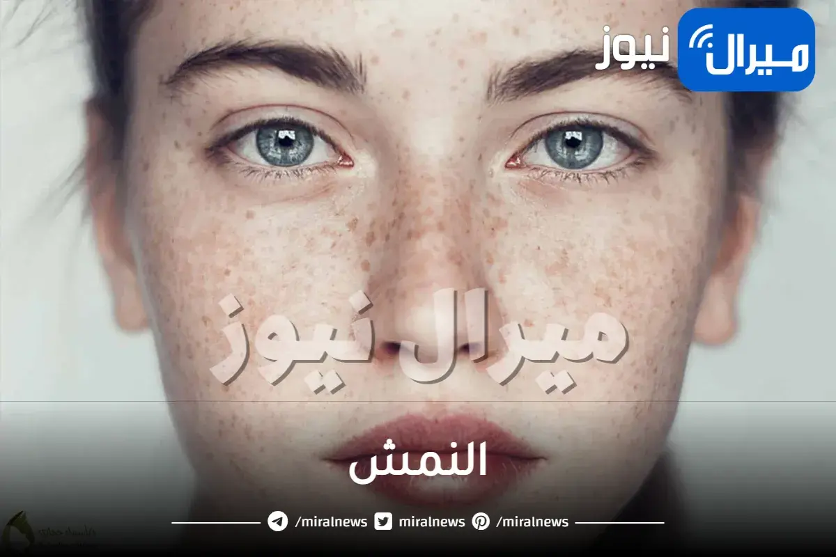 النمش.. أسبابه وعلاجه