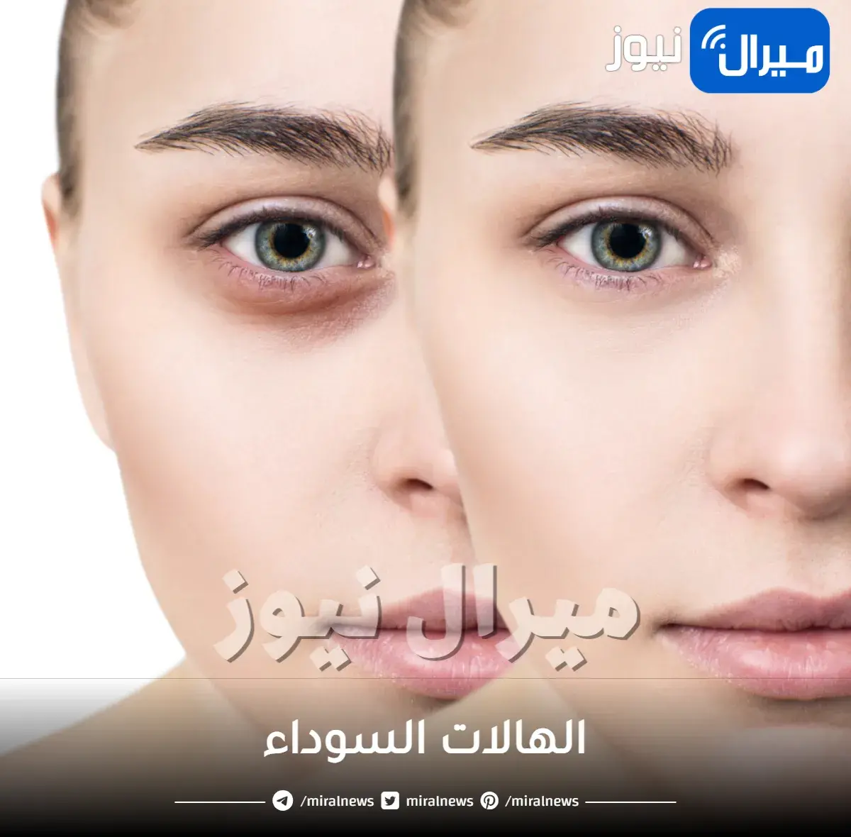 الهالات السوداء: أسباب ظهور الهالات السوداء وطرق علاجها