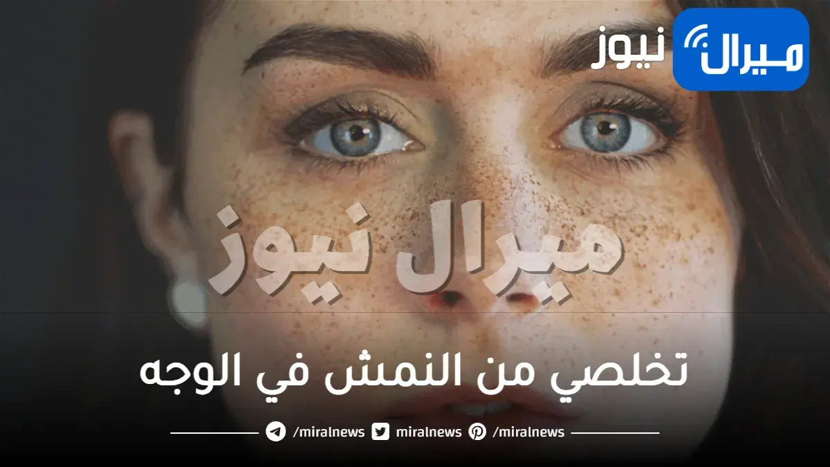 تخلصي من النمش في الوجه بهذه الوصفات