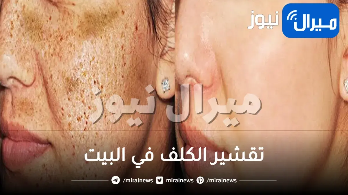 تقشير الكلف في البيت