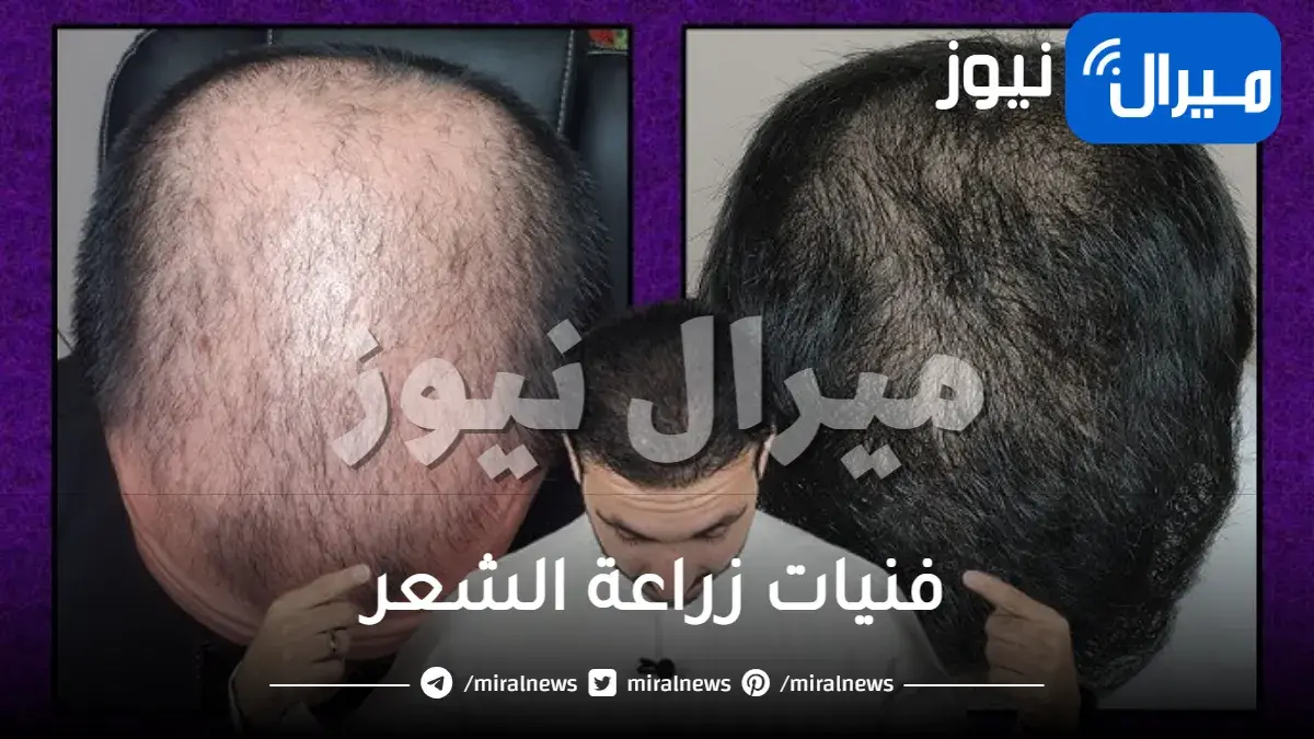 فنيات زراعة الشعر مع الدكتور وائل غانم