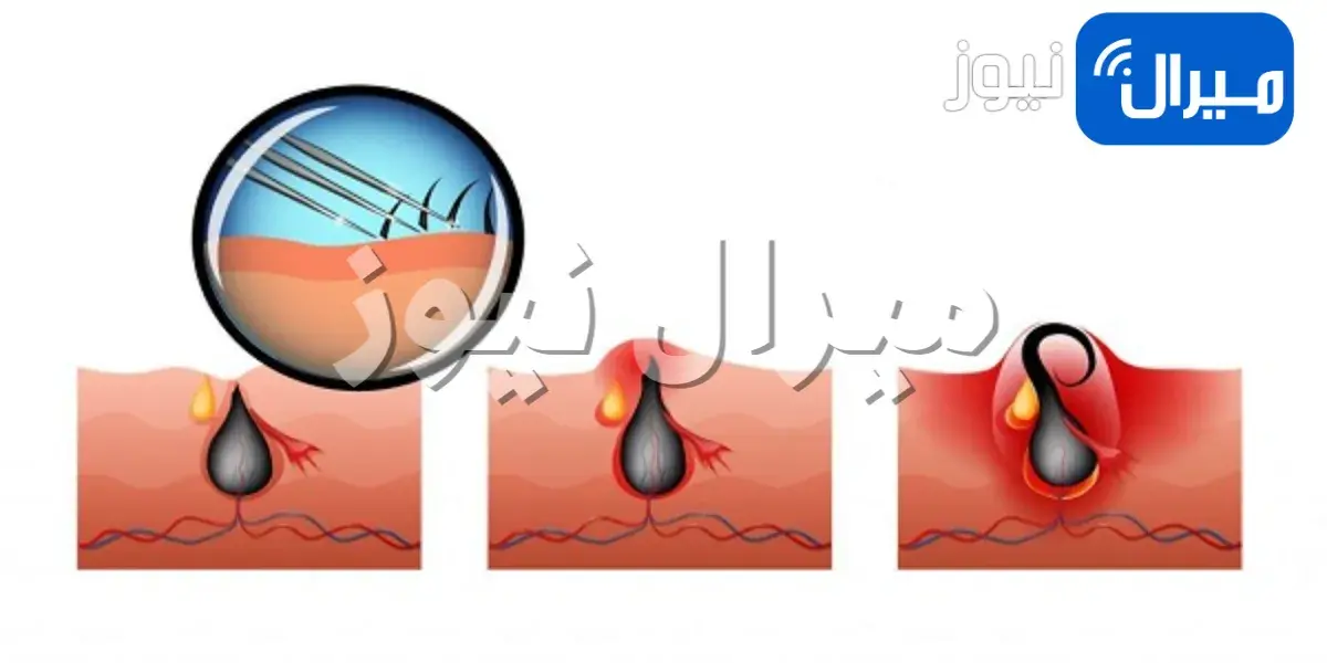 كيف تتخلص من نمو الشعر تحت الجلد في اللحية
