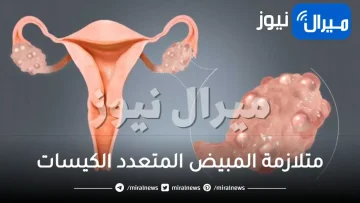 متلازمة المبيض المتعدد الكيسات