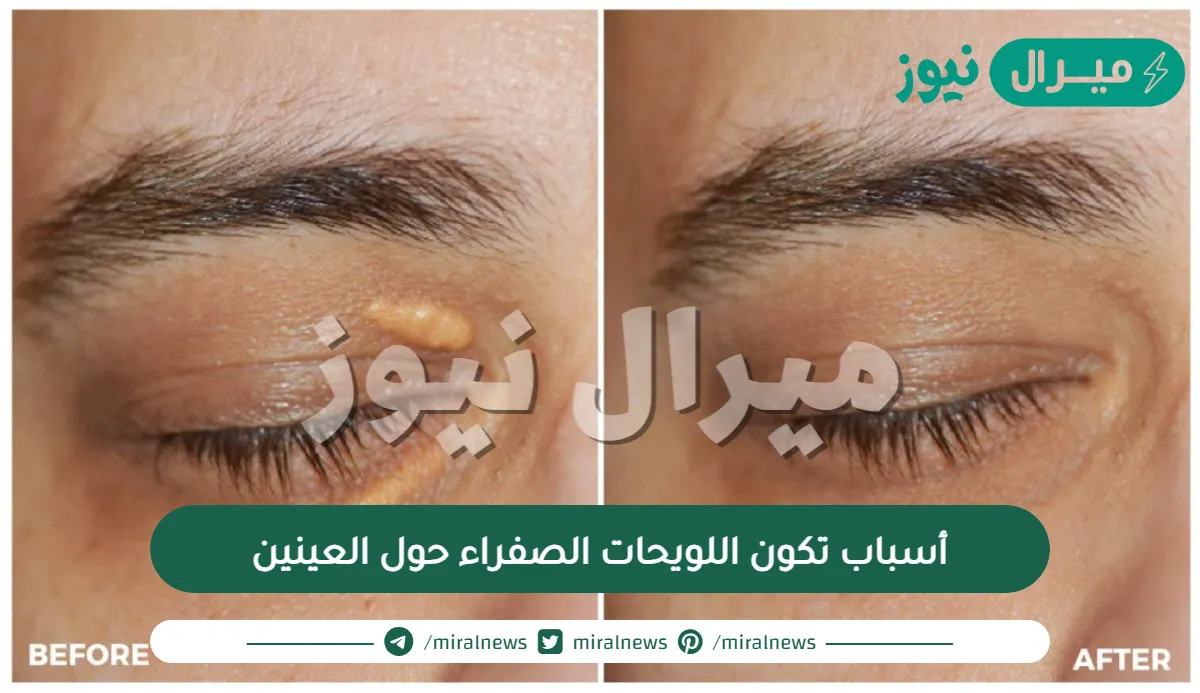 أسباب تكون اللويحات الصفراء حول العينين