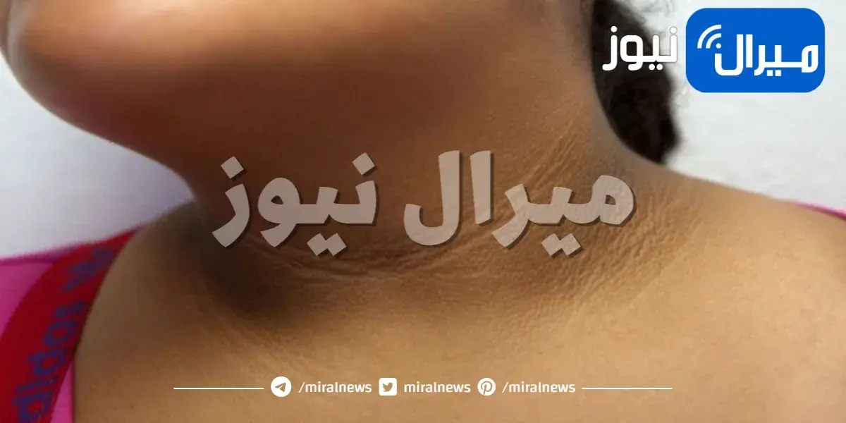 أسباب مشكلة الرقبة السوداء وطريقة علاجها