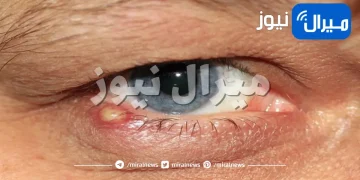 أسباب وطرق علاج دمل الجفن