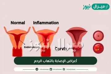 أعراض الإصابة بالتهاب الرحم