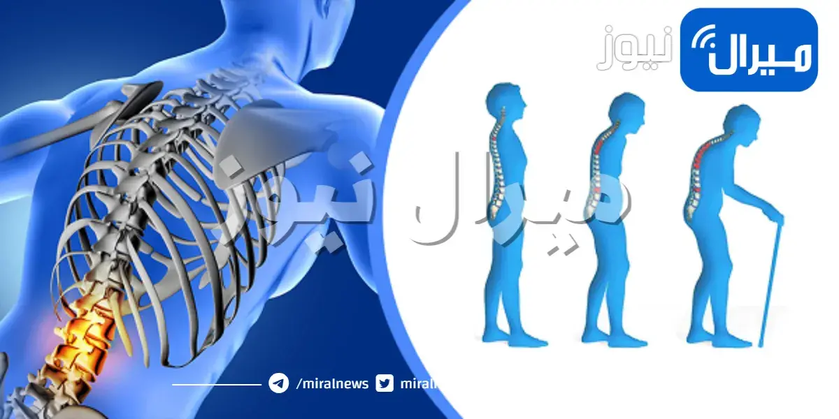 أعراض وأسباب هشاشة العظام