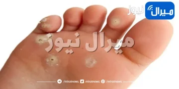 أنواع الثآليل (عين السمكة) وعلاجاتها وكيفية الوقاية منها